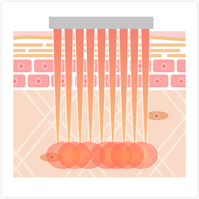 波長：10,600nm