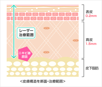 皮膚断面図（レーザーの照射可能範囲とニキビ跡の位置）