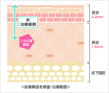 皮膚断面図（ニキビ跡の位置と針治療が可能な範囲）