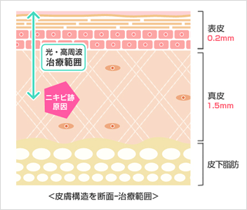 皮膚断面図（ニキビ跡の位置と光・熱治療が可能な範囲）