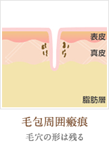 毛包周囲瘢痕：毛穴の形は残る