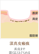 深真皮瘢痕：真皮まで深く広くえぐられる