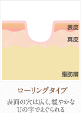 ローリングタイプ：表面の穴は広く、緩やかなUの字でえぐられる