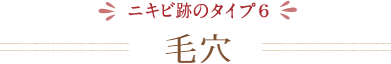 ニキビ跡のタイプ6 毛穴